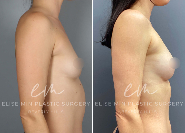 This is a 32 year-old woman who wanted a natural boost to her breasts without using any implants. She desired to go from her AA cup size to an A cup size. During the operation, she had 135cc of fat cells injected into her right breast and 88cc of fat cells into her left breast. At her six-month postoperative visit, she was thrilled with her results and couldn’t be happier. 