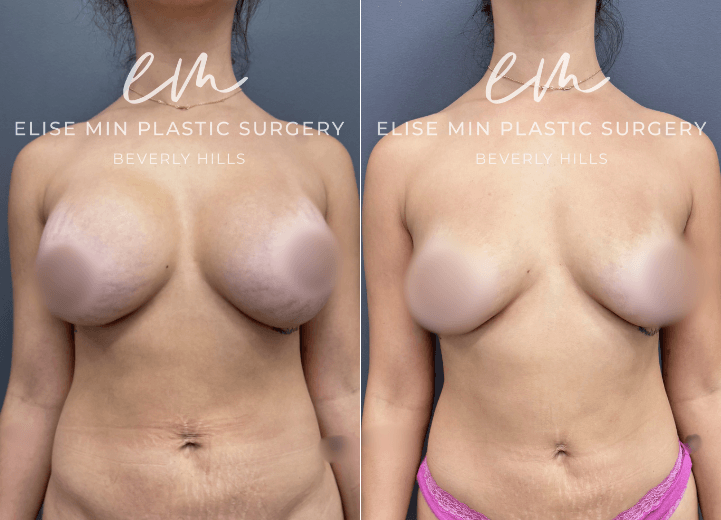 Breast Implant Removal - This 28-year-old woman desired removal of her silicone breast implants and correction of an animation deformity caused by the position of her implants beneath the pectoral muscle. Her surgical plan was guided by the MinLine™ Philosophy, an individualized approach focused on creating beautiful, proportional breasts while prioritizing shape, long-term support, and safety. She underwent implant removal with correction of the pectoral muscle, along with fat transfer to the breasts to restore volume and improve symmetry. A total of 170cc of fat was placed in the left breast and 200cc in the right.