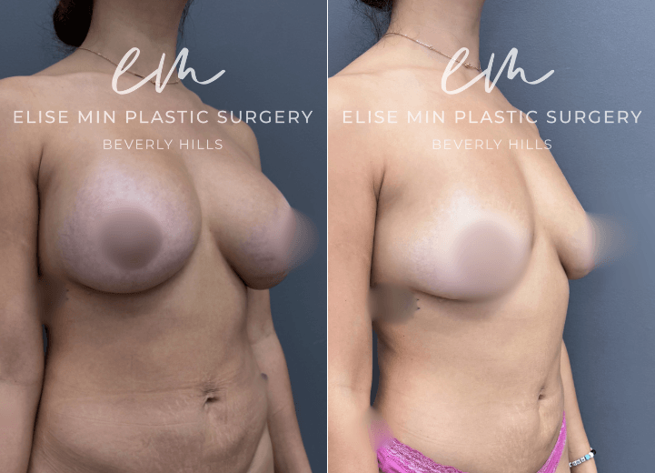 Breast Implant Removal - This 28-year-old woman desired removal of her silicone breast implants and correction of an animation deformity caused by the position of her implants beneath the pectoral muscle. Her surgical plan was guided by the MinLine™ Philosophy, an individualized approach focused on creating beautiful, proportional breasts while prioritizing shape, long-term support, and safety. She underwent implant removal with correction of the pectoral muscle, along with fat transfer to the breasts to restore volume and improve symmetry. A total of 170cc of fat was placed in the left breast and 200cc in the right.