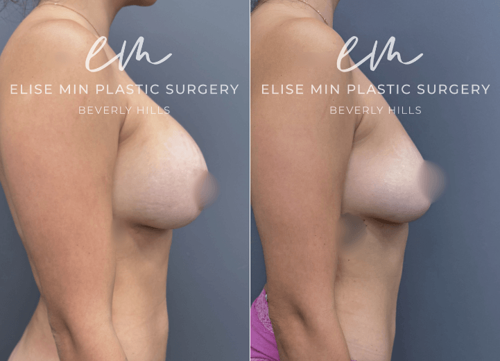 Breast Implant Removal - This 28-year-old woman desired removal of her silicone breast implants and correction of an animation deformity caused by the position of her implants beneath the pectoral muscle. Her surgical plan was guided by the MinLine™ Philosophy, an individualized approach focused on creating beautiful, proportional breasts while prioritizing shape, long-term support, and safety. She underwent implant removal with correction of the pectoral muscle, along with fat transfer to the breasts to restore volume and improve symmetry. A total of 170cc of fat was placed in the left breast and 200cc in the right.