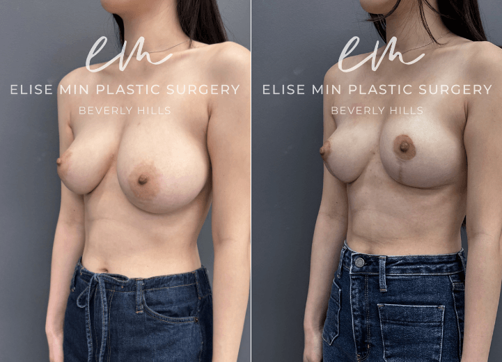 Left breast reduction and right breast lift (mastopexy)  - This is a 25-year-old patient with breast asymmetry, with the left breast measuring approximately a C cup and the right breast a B cup. She desired improved balance and symmetry and underwent a left breast reduction and right breast lift (mastopexy), both performed using a lollipop vertical incision pattern. Her results achieved a more proportionate, symmetrical shape while maintaining a natural appearance. She is thrilled with her postoperative symmetry and feels much more confident in clothing and swimwear.