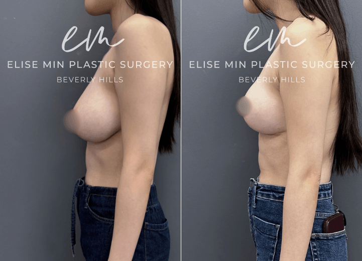 Left breast reduction and right breast lift (mastopexy)  - This is a 25-year-old patient with breast asymmetry, with the left breast measuring approximately a C cup and the right breast a B cup. She desired improved balance and symmetry and underwent a left breast reduction and right breast lift (mastopexy), both performed using a lollipop vertical incision pattern. Her results achieved a more proportionate, symmetrical shape while maintaining a natural appearance. She is thrilled with her postoperative symmetry and feels much more confident in clothing and swimwear.