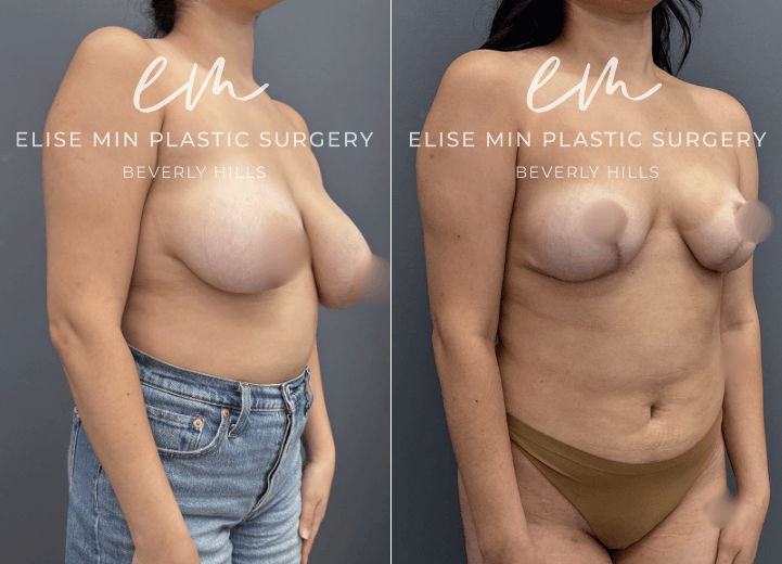 Breast Reduction - This 28 year old woman had long-standing breast asymmetry, with one breast approximately a D cup and the other a C cup. Her goal was a balanced, proportional result in the small B to small C cup range. Her breast reduction was guided by the MinLine™ Philosophy, which focuses on creating beautiful shape and symmetry while using the least scar necessary for each individual patient. To achieve a more balanced result, 460 grams of tissue were removed from the left breast and 180 grams from the right.