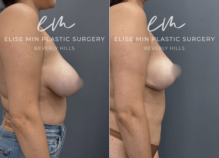 Breast Reduction - This 28 year old woman had long-standing breast asymmetry, with one breast approximately a D cup and the other a C cup. Her goal was a balanced, proportional result in the small B to small C cup range. Her breast reduction was guided by the MinLine™ Philosophy, which focuses on creating beautiful shape and symmetry while using the least scar necessary for each individual patient. To achieve a more balanced result, 460 grams of tissue were removed from the left breast and 180 grams from the right.