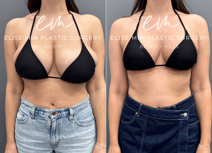 Breast reduction with liposuction of lateral chest wall - This is a 37-year-old woman who had been considering breast reduction surgery for nearly two decades, dating back to her teenage years. Preoperatively, she wore a G-cup bra and underwent a bilateral breast reduction using a modified vertical L-scar technique. A total of 694 grams was removed from the left breast and 433 grams from the right breast to address significant asymmetry. Following surgery, she feels that her torso appears longer and more proportionate, and she has experienced significant relief of the shoulder and neck discomfort that had bothered her for many years.