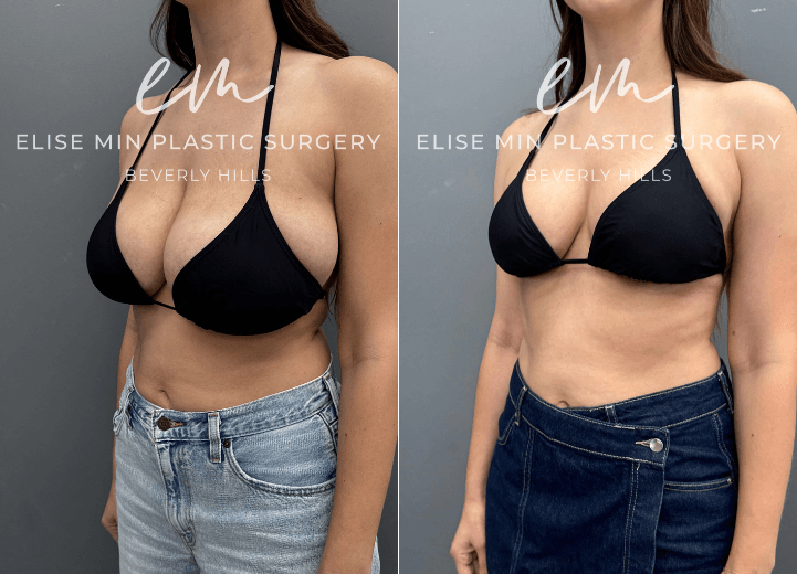 Breast reduction with liposuction of lateral chest wall - This is a 37-year-old woman who had been considering breast reduction surgery for nearly two decades, dating back to her teenage years. Preoperatively, she wore a G-cup bra and underwent a bilateral breast reduction using a modified vertical L-scar technique. A total of 694 grams was removed from the left breast and 433 grams from the right breast to address significant asymmetry. Following surgery, she feels that her torso appears longer and more proportionate, and she has experienced significant relief of the shoulder and neck discomfort that had bothered her for many years.