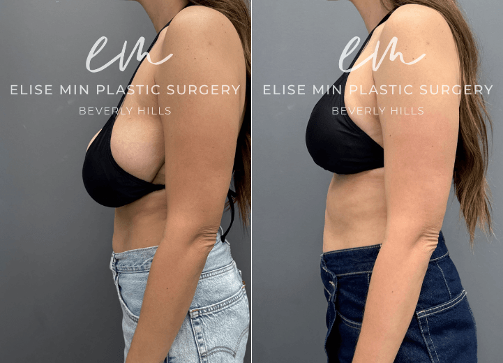 Breast reduction with liposuction of lateral chest wall - This is a 37-year-old woman who had been considering breast reduction surgery for nearly two decades, dating back to her teenage years. Preoperatively, she wore a G-cup bra and underwent a bilateral breast reduction using a modified vertical L-scar technique. A total of 694 grams was removed from the left breast and 433 grams from the right breast to address significant asymmetry. Following surgery, she feels that her torso appears longer and more proportionate, and she has experienced significant relief of the shoulder and neck discomfort that had bothered her for many years.