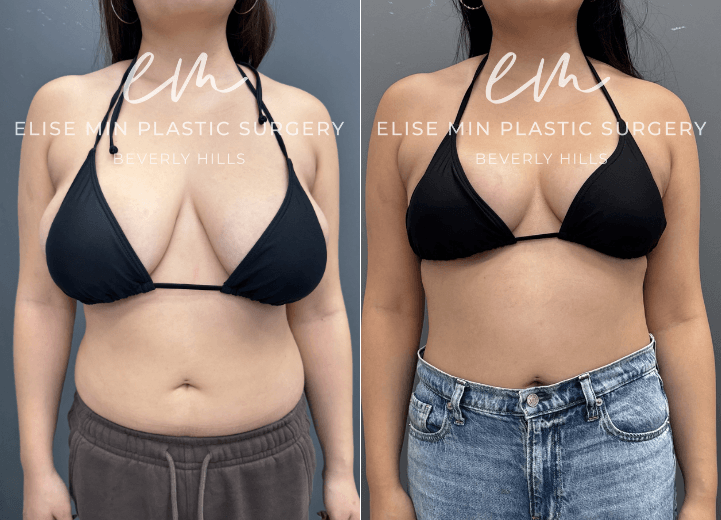 Breast Reduction - This 27 year old woman wanted to be more proportional to her body. She underwent a breast reduction guided by the MinLine™ Philosophy, an individualized approach that focuses on creating beautiful, proportional breasts while using the least scar necessary without compromising shape, long term support, or safety. Her surgical plan included an MinLine ™ scar pattern with liposuction of the surrounding tissue to optimize contour, resulting in a C/D cup that was better balanced with her frame.
