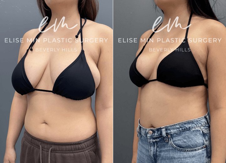 Breast Reduction - This 27 year old woman wanted to be more proportional to her body. She underwent a breast reduction guided by the MinLine™ Philosophy, an individualized approach that focuses on creating beautiful, proportional breasts while using the least scar necessary without compromising shape, long term support, or safety. Her surgical plan included an MinLine ™ scar pattern with liposuction of the surrounding tissue to optimize contour, resulting in a C/D cup that was better balanced with her frame.