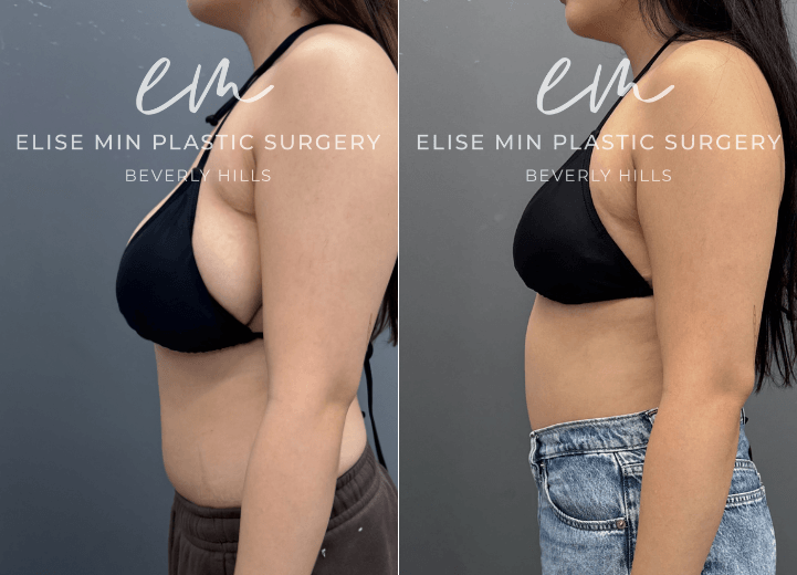 Breast Reduction - This 27 year old woman wanted to be more proportional to her body. She underwent a breast reduction guided by the MinLine™ Philosophy, an individualized approach that focuses on creating beautiful, proportional breasts while using the least scar necessary without compromising shape, long term support, or safety. Her surgical plan included an MinLine ™ scar pattern with liposuction of the surrounding tissue to optimize contour, resulting in a C/D cup that was better balanced with her frame.
