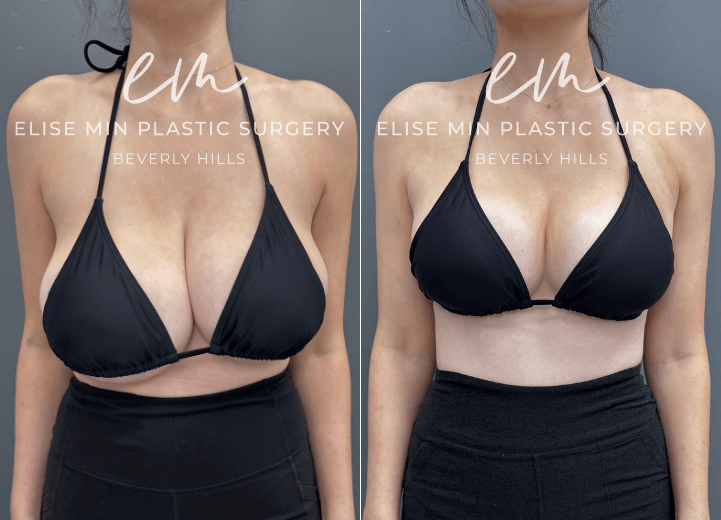 Breast reduction with liposuction of lateral chest wall  - This is a 30-year-old patient with a history of 32H breasts and noticeable asymmetry and hypertrophy who underwent a modified vertical L-scar breast reduction to achieve a more balanced, proportionate figure. She now feels lighter and can fit into a bikini bathing suit for the first time in her life without any scars showing through. 