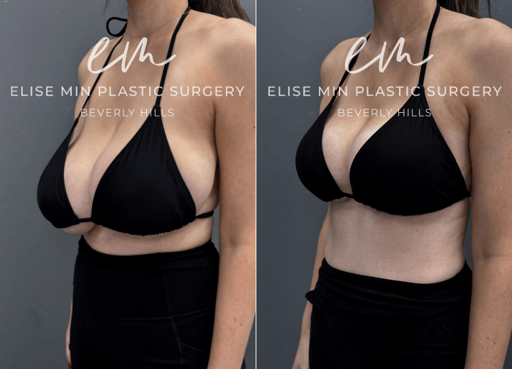 Breast reduction with liposuction of lateral chest wall  - This is a 30-year-old patient with a history of 32H breasts and noticeable asymmetry and hypertrophy who underwent a modified vertical L-scar breast reduction to achieve a more balanced, proportionate figure. She now feels lighter and can fit into a bikini bathing suit for the first time in her life without any scars showing through. 