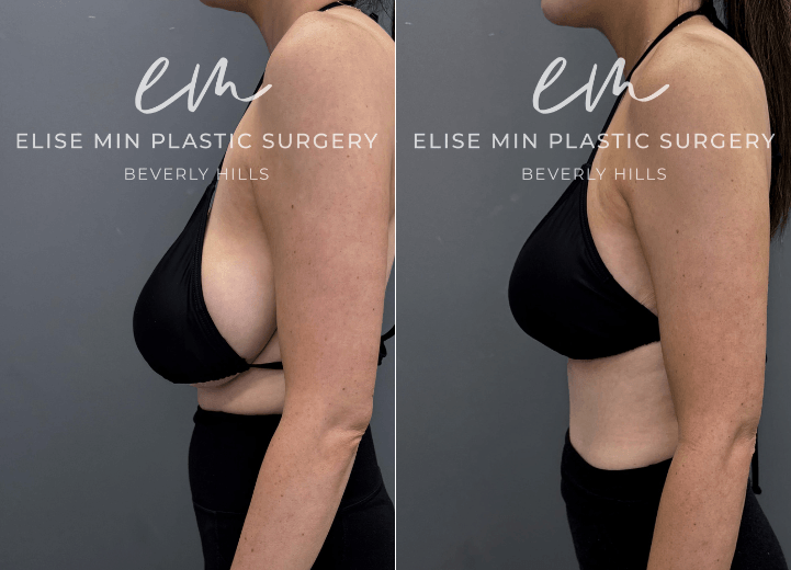Breast reduction with liposuction of lateral chest wall  - This is a 30-year-old patient with a history of 32H breasts and noticeable asymmetry and hypertrophy who underwent a modified vertical L-scar breast reduction to achieve a more balanced, proportionate figure. She now feels lighter and can fit into a bikini bathing suit for the first time in her life without any scars showing through. 