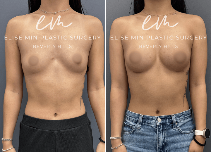 Breast Augmentation - This 23 year old woman wanted a subtle enhancement, going from an A cup to a B cup. Because she leads a very active lifestyle, it was important to choose an approach that would provide a natural look and feel while moving comfortably with her body. Her surgical plan included subfascial placement of Motiva Ergonomix™ SmoothSilk Round Mini (ESRM) 170 cc implants through an inframammary fold incision, guided by my MinLine™ Philosophy. Every aspect of her procedure was individualized to achieve a balanced, proportionate result while using the least scar necessary.