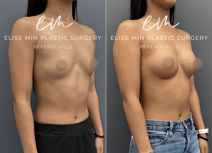 Breast Augmentation - This 23 year old woman wanted a subtle enhancement, going from an A cup to a B cup. Because she leads a very active lifestyle, it was important to choose an approach that would provide a natural look and feel while moving comfortably with her body. Her surgical plan included subfascial placement of Motiva Ergonomix™ SmoothSilk Round Mini (ESRM) 170 cc implants through an inframammary fold incision, guided by my MinLine™ Philosophy. Every aspect of her procedure was individualized to achieve a balanced, proportionate result while using the least scar necessary.