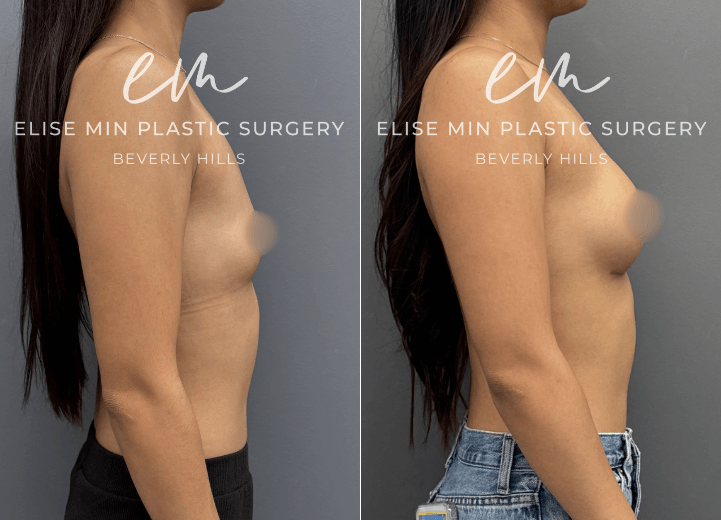 Breast Augmentation - This 23 year old woman wanted a subtle enhancement, going from an A cup to a B cup. Because she leads a very active lifestyle, it was important to choose an approach that would provide a natural look and feel while moving comfortably with her body. Her surgical plan included subfascial placement of Motiva Ergonomix™ SmoothSilk Round Mini (ESRM) 170 cc implants through an inframammary fold incision, guided by my MinLine™ Philosophy. Every aspect of her procedure was individualized to achieve a balanced, proportionate result while using the least scar necessary.