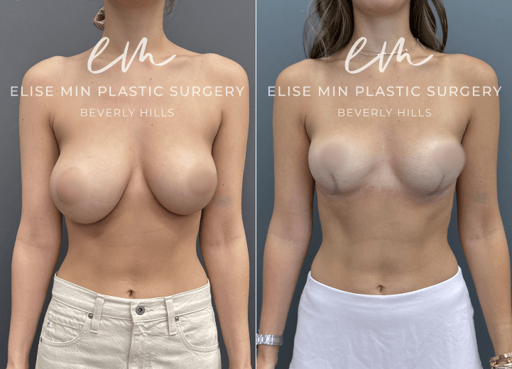 Breast Reduction - This 26 year old woman had significant breast asymmetry, wearing approximately a DDD cup on the right and a D cup on the left. She underwent a breast reduction guided by the MinLine™ Philosophy, an individualized approach that focuses on creating beautiful, proportionate breasts while using the least scar necessary without compromising shape or long term support. Her surgical plan included a modified short L scar pattern, with 270 grams of tissue removed from the right breast and 80 grams from the left to achieve a balanced C cup.