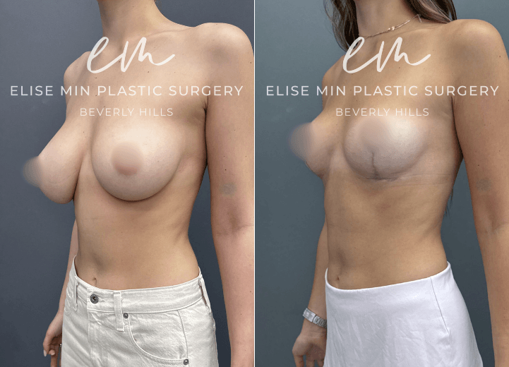 Breast Reduction - This 26 year old woman had significant breast asymmetry, wearing approximately a DDD cup on the right and a D cup on the left. She underwent a breast reduction guided by the MinLine™ Philosophy, an individualized approach that focuses on creating beautiful, proportionate breasts while using the least scar necessary without compromising shape or long term support. Her surgical plan included a modified short L scar pattern, with 270 grams of tissue removed from the right breast and 80 grams from the left to achieve a balanced C cup.