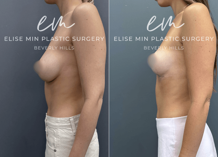 Breast Reduction - This 26 year old woman had significant breast asymmetry, wearing approximately a DDD cup on the right and a D cup on the left. She underwent a breast reduction guided by the MinLine™ Philosophy, an individualized approach that focuses on creating beautiful, proportionate breasts while using the least scar necessary without compromising shape or long term support. Her surgical plan included a modified short L scar pattern, with 270 grams of tissue removed from the right breast and 80 grams from the left to achieve a balanced C cup.