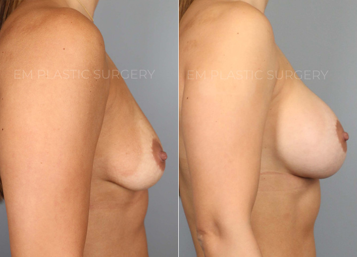 A mom of an energetic, sweet toddler, this patient, aged 35, was seeking breast augmentation to address the changes her body underwent during and after pregnancy. The rewarding journey of becoming a mom has led to a loss of breast volume and pre-pregnancy breast shape. She was wearing a 34B bra prior to surgeryand wanted to look natural but larger. After her breast augmentation procedure, she was excited to share that there are date nights where she can now wear cute dresses with a natural, sexy cleavage without the hassle of wearing strapless bras and stick-on bras that she needed in the past.