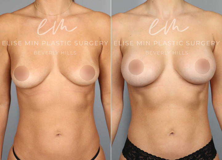 A mom of an energetic, sweet toddler, this patient, aged 35, was seeking breast augmentation to address the changes her body underwent during and after pregnancy. The rewarding journey of becoming a mom has led to a loss of breast volume and pre-pregnancy breast shape. She was wearing a 34B bra prior to surgery and wanted to look natural but larger. After her breast augmentation procedure, she was excited to share that there are date nights where she can now wear cute dresses with a natural, sexy cleavage without the hassle of wearing strapless bras and stick-on bras that she needed in the past.