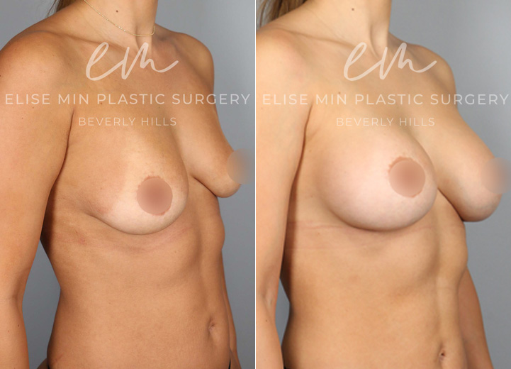 A mom of an energetic, sweet toddler, this patient, aged 35, was seeking breast augmentation to address the changes her body underwent during and after pregnancy. The rewarding journey of becoming a mom has led to a loss of breast volume and pre-pregnancy breast shape. She was wearing a 34B bra prior to surgery and wanted to look natural but larger. After her breast augmentation procedure, she was excited to share that there are date nights where she can now wear cute dresses with a natural, sexy cleavage without the hassle of wearing strapless bras and stick-on bras that she needed in the past.