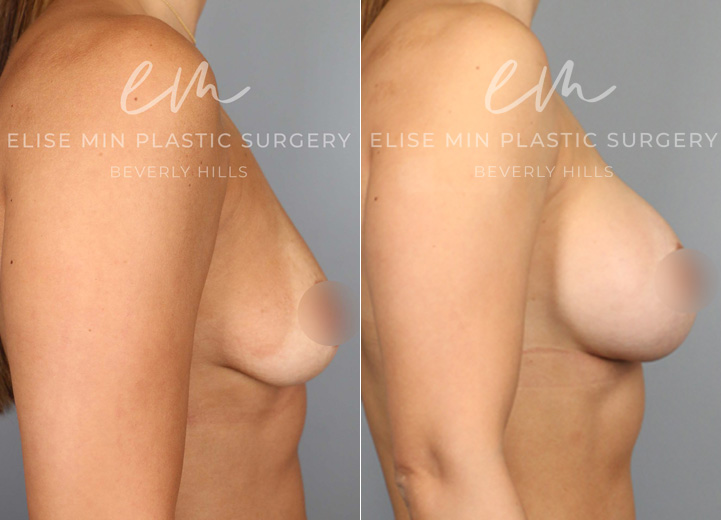A mom of an energetic, sweet toddler, this patient, aged 35, was seeking breast augmentation to address the changes her body underwent during and after pregnancy. The rewarding journey of becoming a mom has led to a loss of breast volume and pre-pregnancy breast shape. She was wearing a 34B bra prior to surgery and wanted to look natural but larger. After her breast augmentation procedure, she was excited to share that there are date nights where she can now wear cute dresses with a natural, sexy cleavage without the hassle of wearing strapless bras and stick-on bras that she needed in the past.