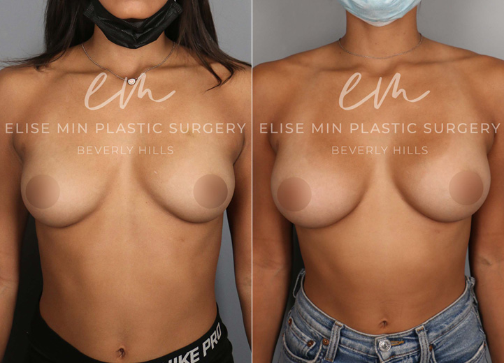 This is a 25 year-old former gymnast who loves working out and continues to do gymnastics as a hobby. Prior to her consultation, she didn’t know her bra cup size but she knew she wanted a larger but natural breast appearance that would allow her to feel more confident. However, it was important to her that her breasts would not be too large that they could hinder her from her current physical activities. So we decided to go with 210cc moderate profile implants to give her the natural boost while it fits her wider chest width. After the operation, she was back to doing her usual workouts in four weeks and feeling great in her workout gear. 