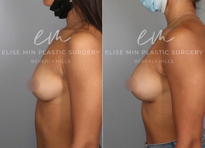 This is a 25 year-old former gymnast who loves working out and continues to do gymnastics as a hobby. Prior to her consultation, she didn’t know her bra cup size but she knew she wanted a larger but natural breast appearance that would allow her to feel more confident. However, it was important to her that her breasts would not be too large that they could hinder her from her current physical activities. So we decided to go with 210cc moderate profile implants to give her the natural boost while it fits her wider chest width. After the operation, she was back to doing her usual workouts in four weeks and feeling great in her workout gear. 