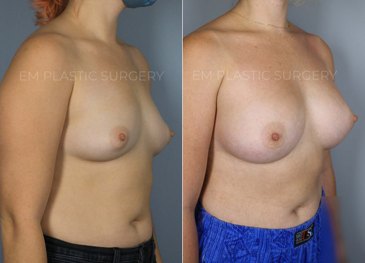 This delightful patient in her 20s was seeking breast augmentation to achieve a more proportionate and balanced figure. She expressed that bras in general did not fit her very well. Upon examination, it was found that she would fit into an estimated A cup-sized bra before the procedure, and she desired to be a C cup size. She also had wide breast dimensions at baseline, so the tailored surgical plan for her unique anatomy was to use low-plus profile breast implants. This allowed her to achieve a result that is natural and proportional as the breast implants filled out her wider chest.