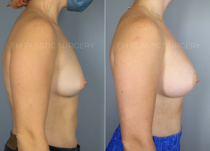 This delightful patient in her 20s was seeking breast augmentation to achieve a more proportionate and balanced figure. She expressed that bras in general did not fit her very well. Upon examination, it was found that she would fit into an estimated A cup-sized bra before the procedure, and she desired to be a C cup size. She also had wide breast dimensions at baseline, so the tailored surgical plan for her unique anatomy was to use low-plus profile breast implants. This allowed her to achieve a result that is natural and proportional as the breast implants filled out her wider chest.