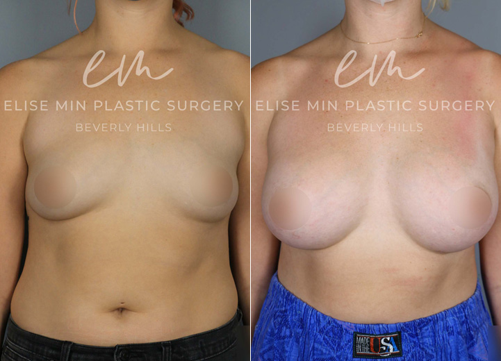 This delightful patient in her 20s was seeking breast augmentation to achieve a more proportionate and balanced figure. She expressed that bras in general did not fit her very well. Upon examination, it was found that she would fit into an estimated A cup-sized bra before the procedure, and she desired to be a C cup size. She also had wide breast dimensions at baseline, so the tailored surgical plan for her unique anatomy was to use low-plus profile breast implants. This allowed her to achieve a result that is natural and proportional as the breast implants filled out her wider chest.