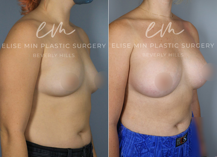 This delightful patient in her 20s was seeking breast augmentation to achieve a more proportionate and balanced figure. She expressed that bras in general did not fit her very well. Upon examination, it was found that she would fit into an estimated A cup-sized bra before the procedure, and she desired to be a C cup size. She also had wide breast dimensions at baseline, so the tailored surgical plan for her unique anatomy was to use low-plus profile breast implants. This allowed her to achieve a result that is natural and proportional as the breast implants filled out her wider chest.