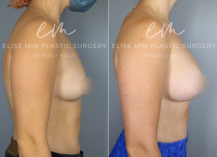 This delightful patient in her 20s was seeking breast augmentation to achieve a more proportionate and balanced figure. She expressed that bras in general did not fit her very well. Upon examination, it was found that she would fit into an estimated A cup-sized bra before the procedure, and she desired to be a C cup size. She also had wide breast dimensions at baseline, so the tailored surgical plan for her unique anatomy was to use low-plus profile breast implants. This allowed her to achieve a result that is natural and proportional as the breast implants filled out her wider chest.