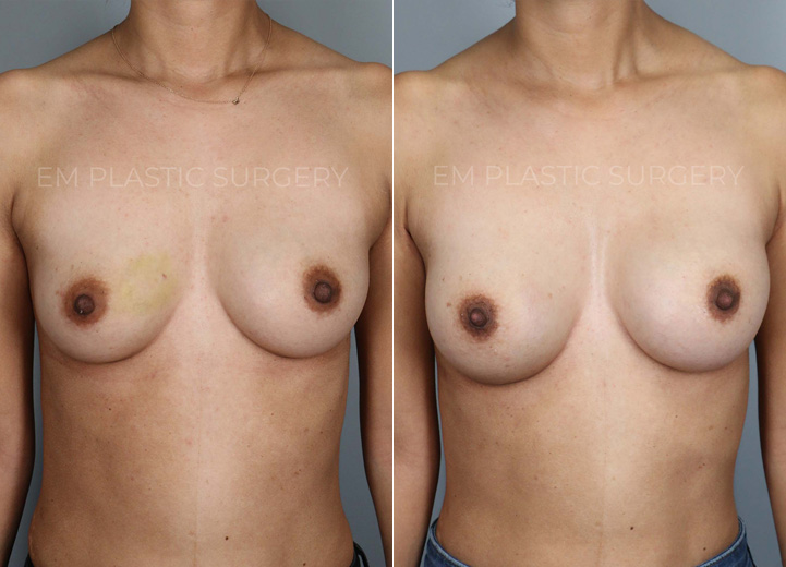 This is a 30 year-old woman who was undergoing an excisional biopsy of a benign lesion in the
right breast by a breast surgeon, and she wanted a very modest increase in her breast size
during the same surgery. Her main desire was for her breasts to fill in her current 30D bra
better instead of actually increasing the bra cup size. So we decided to go with the smallest
implant that fits her chest and had it placed under the muscle. She loves the modest increase
and loves how she feels in her bra and her clothes after the surgery.