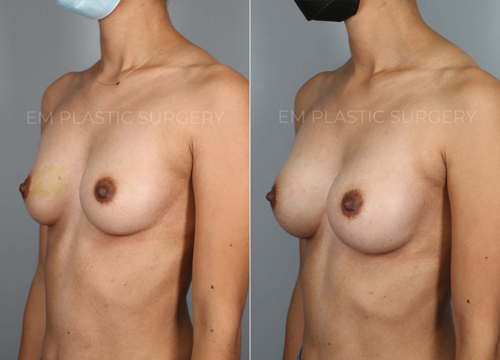 This is a 30 year-old woman who was undergoing an excisional biopsy of a benign lesion in the
right breast by a breast surgeon, and she wanted a very modest increase in her breast size
during the same surgery. Her main desire was for her breasts to fill in her current 30D bra
better instead of actually increasing the bra cup size. So we decided to go with the smallest
implant that fits her chest and had it placed under the muscle. She loves the modest increase
and loves how she feels in her bra and her clothes after the surgery.