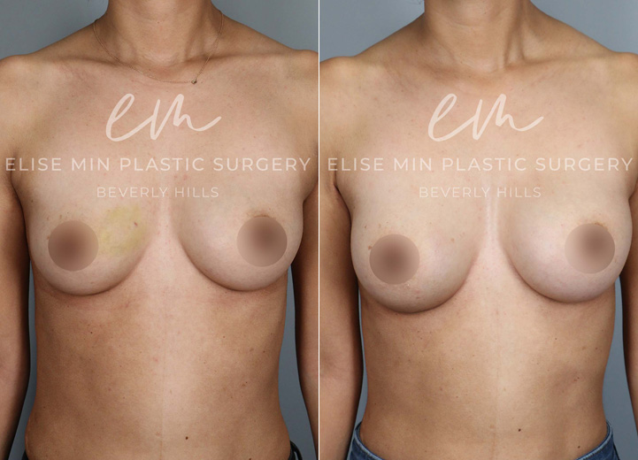 This is a 30 year-old woman who was undergoing an excisional biopsy of a benign lesion in the right breast by a breast surgeon, and she wanted a very modest increase in her breast size during the same surgery. Her main desire was for her breasts to fill in her current 30D bra better instead of actually increasing the bra cup size. So we decided to go with the smallest implant that fits her chest and had it placed under the muscle. She loves the modest increase and loves how she feels in her bra and her clothes after the surgery. 