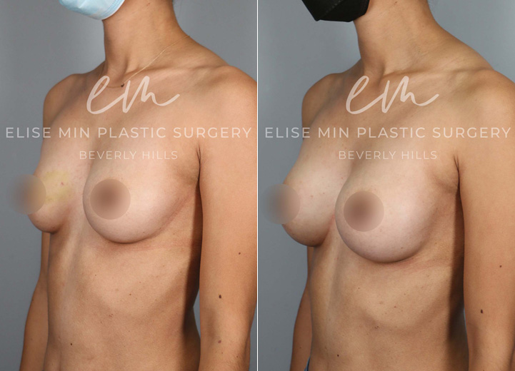 This is a 30 year-old woman who was undergoing an excisional biopsy of a benign lesion in the right breast by a breast surgeon, and she wanted a very modest increase in her breast size during the same surgery. Her main desire was for her breasts to fill in her current 30D bra better instead of actually increasing the bra cup size. So we decided to go with the smallest implant that fits her chest and had it placed under the muscle. She loves the modest increase and loves how she feels in her bra and her clothes after the surgery. 