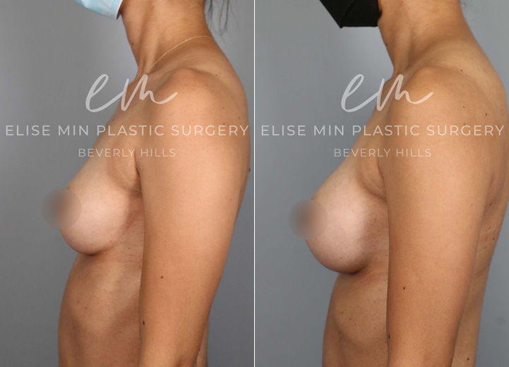 This is a 30 year-old woman who was undergoing an excisional biopsy of a benign lesion in the right breast by a breast surgeon, and she wanted a very modest increase in her breast size during the same surgery. Her main desire was for her breasts to fill in her current 30D bra better instead of actually increasing the bra cup size. So we decided to go with the smallest implant that fits her chest and had it placed under the muscle. She loves the modest increase and loves how she feels in her bra and her clothes after the surgery. 