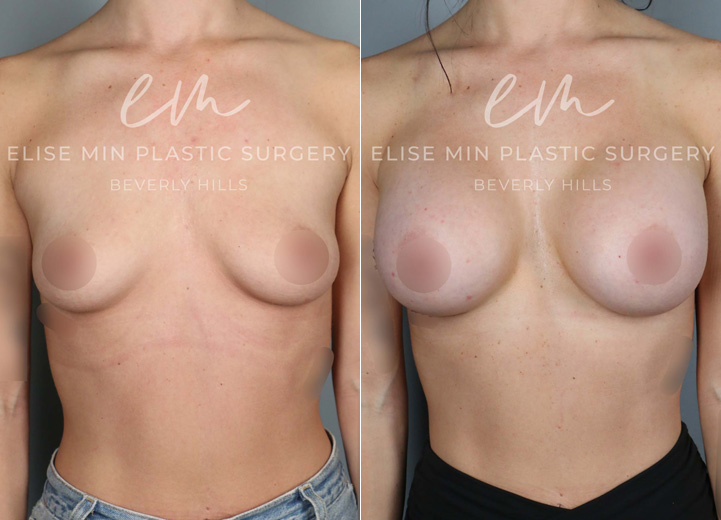 This 25-year-old patient wanted to enhance her curves and achieve a more voluminous look. She went from an A cup to a D cup with silicone breast implants, creating fuller yet natural-looking results. Her new shape beautifully complements her frame while maintaining a soft, balanced appearance.
