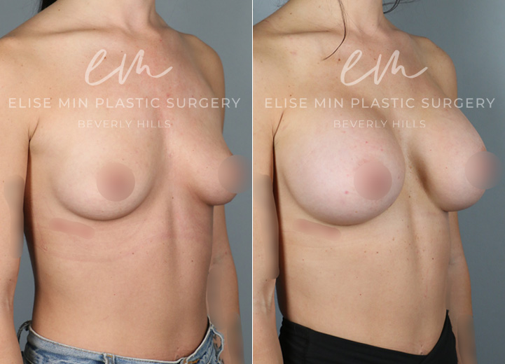 This 25-year-old patient wanted to enhance her curves and achieve a more voluminous look. She went from an A cup to a D cup with silicone breast implants, creating fuller yet natural-looking results. Her new shape beautifully complements her frame while maintaining a soft, balanced appearance.