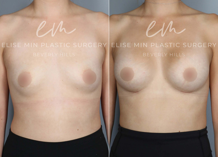 This 32-year-old patient wanted to enhance her natural proportions with added volume. With silicone breast implants, she went from an A cup to a C/D cup, achieving a fuller yet balanced look. Her results not only complement her figure but also gave her a big confidence boost.