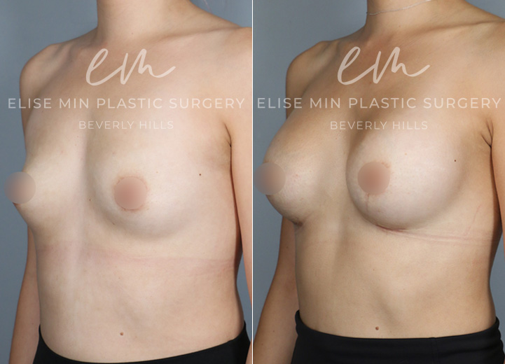 This 32-year-old patient wanted to enhance her natural proportions with added volume. With silicone breast implants, she went from an A cup to a C/D cup, achieving a fuller yet balanced look. Her results not only complement her figure but also gave her a big confidence boost.