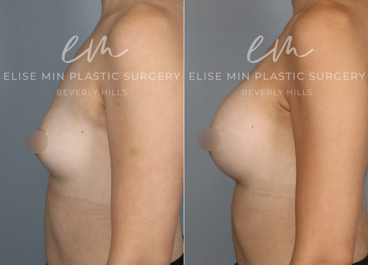 This 32-year-old patient wanted to enhance her natural proportions with added volume. With silicone breast implants, she went from an A cup to a C/D cup, achieving a fuller yet balanced look. Her results not only complement her figure but also gave her a big confidence boost.