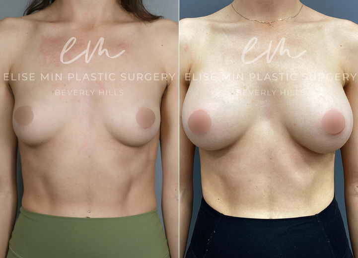 This 25-year-old patient wanted a natural, fuller look that complemented her frame. With silicone breast implants, she increased from an A cup to a C cup, achieving soft, beautifully balanced results.