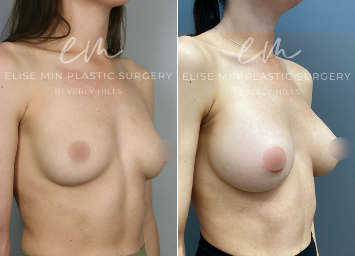 This 25-year-old patient wanted a natural, fuller look that complemented her frame. With silicone breast implants, she increased from an A cup to a C cup, achieving soft, beautifully balanced results.