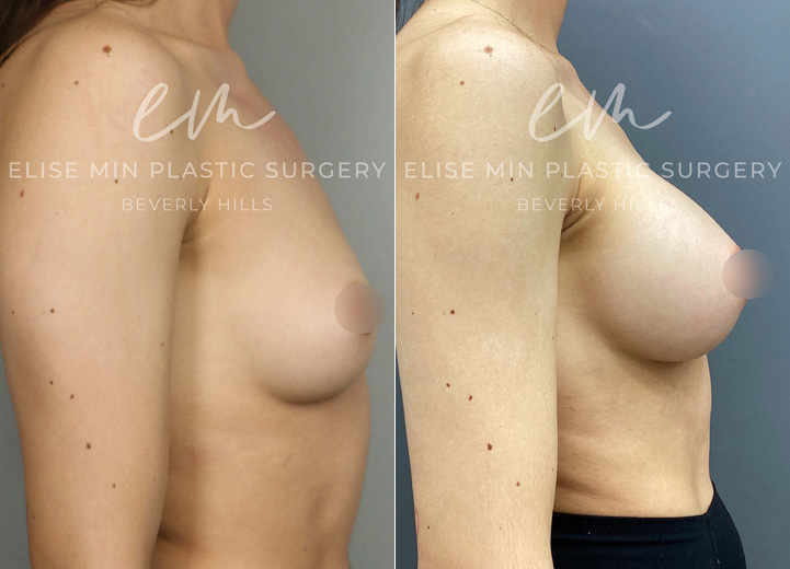 This 25-year-old patient wanted a natural, fuller look that complemented her frame. With silicone breast implants, she increased from an A cup to a C cup, achieving soft, beautifully balanced results.