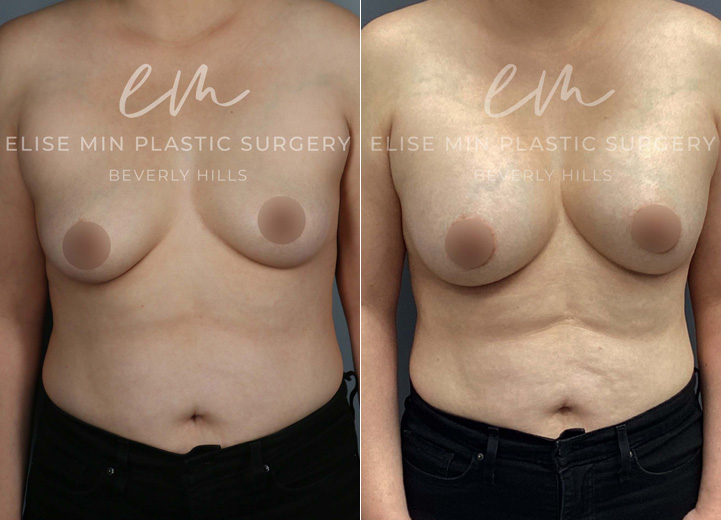 This 44-year-old patient wanted a dramatic yet natural-looking enhancement to better suit her goals. With silicone breast implants, she increased from a B cup to a DD cup, achieving a fuller, more confident look while maintaining a balanced shape.