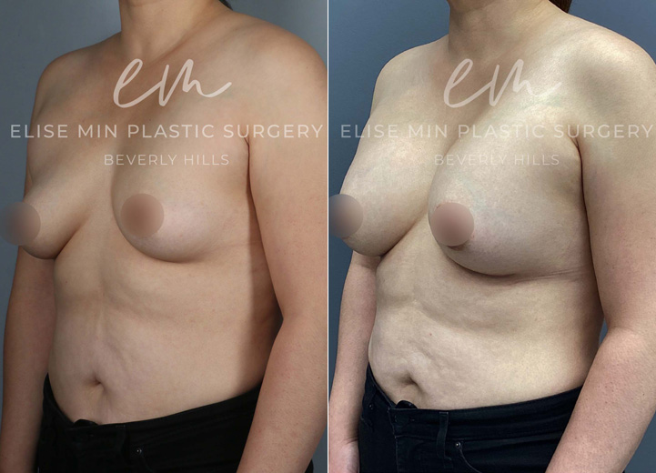 This 44-year-old patient wanted a dramatic yet natural-looking enhancement to better suit her goals. With silicone breast implants, she increased from a B cup to a DD cup, achieving a fuller, more confident look while maintaining a balanced shape.
