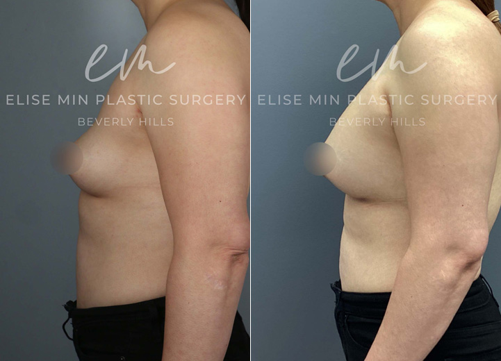 This 44-year-old patient wanted a dramatic yet natural-looking enhancement to better suit her goals. With silicone breast implants, she increased from a B cup to a DD cup, achieving a fuller, more confident look while maintaining a balanced shape.